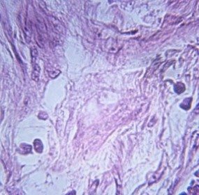 tumor
