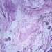 tumor